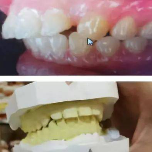 假牙和牙龈出血有什么区别,为什么假牙上面那之牙会出血(图1)